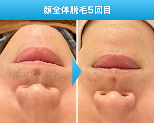 顔全体脱毛5回目