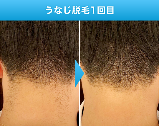 うなじ脱毛1回目