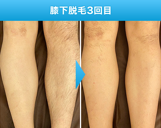膝下脱毛3回目