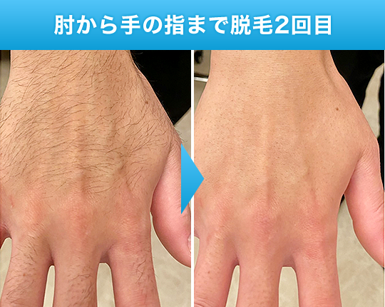 肘から手の指まで脱毛2回目